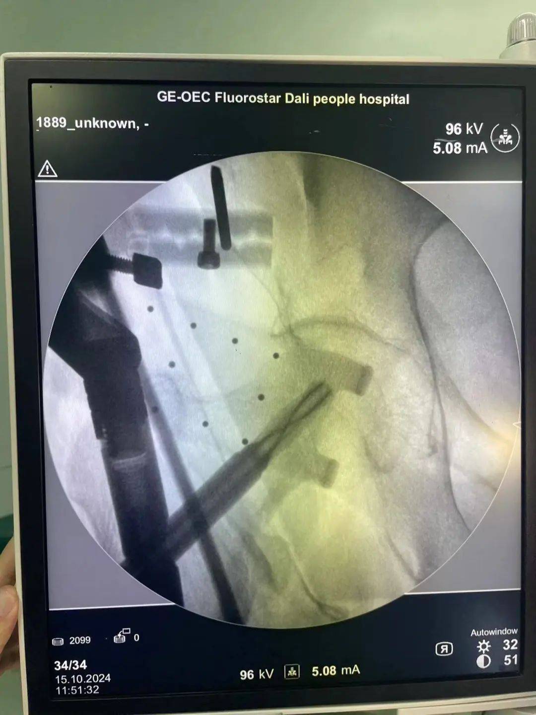 骨科机器人手术“精准到毫米”